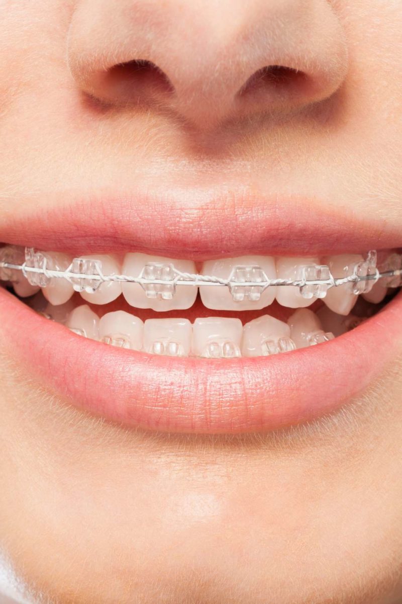 Read more about the article 關於箍牙治療你應該知道的事